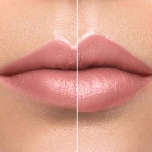 lip-filler-no-needle