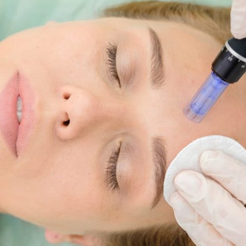Microneedling 1