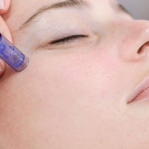 microneedling 2